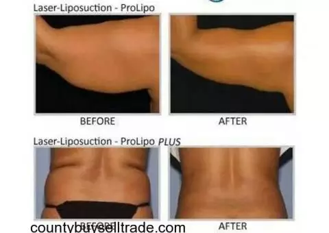Lipo or Face Lift 75% off This week end only Call (424)-666-7724